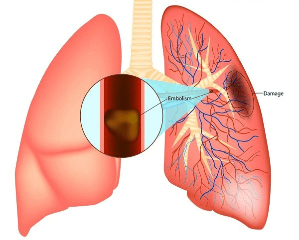  Thuyên tắc phổi là một biến chứng đáng sợ của huyết khối tĩnh mạch sâu