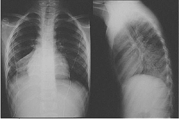 Hình ảnh phổi bị xẹp trên X Quang