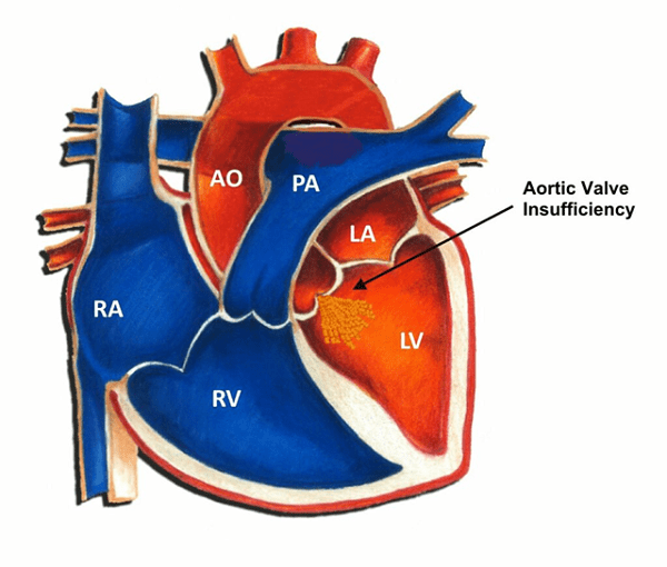  Dòng máu trào ngược trong hở van động mạch chủ