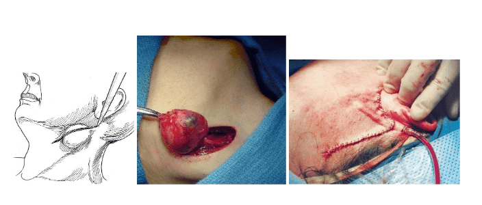 Phẫu thuật cắt bỏ nang khe mang 