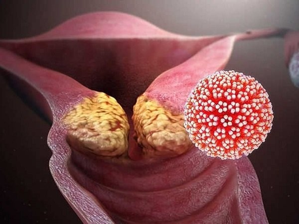 Phần lớn các trường hợp ung thư cổ tử cung đều do nhiễm virut HPV