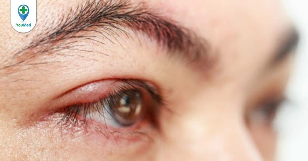Top 3 loại thuốc nhỏ mắt tốt trị mụt lẹo hiện nay