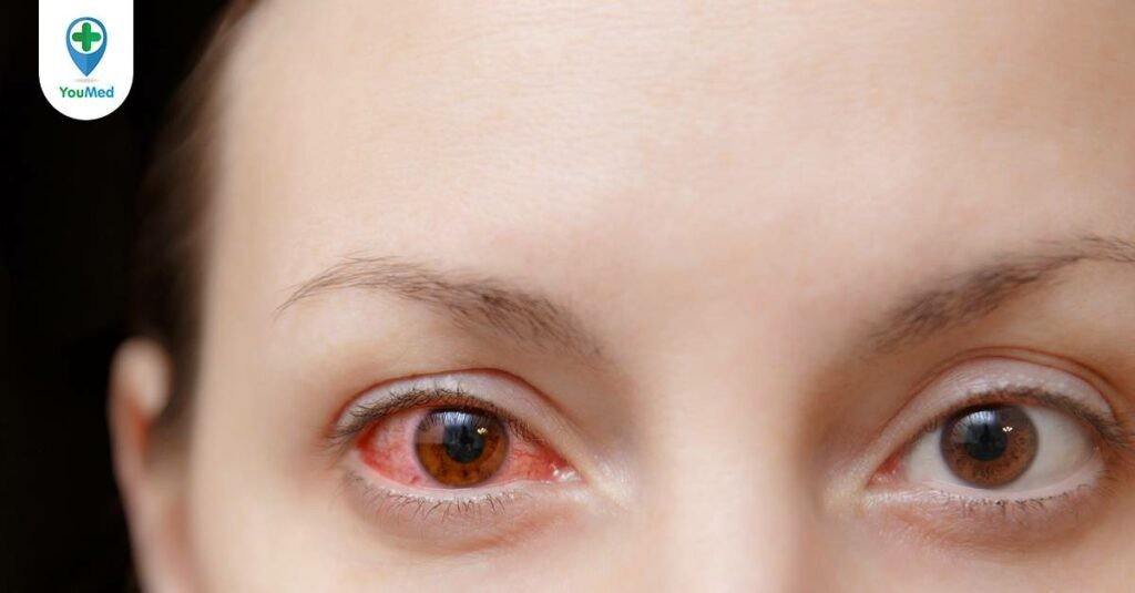 Mách bạn thuốc nhỏ mắt trị viêm giác mạc hiệu quả