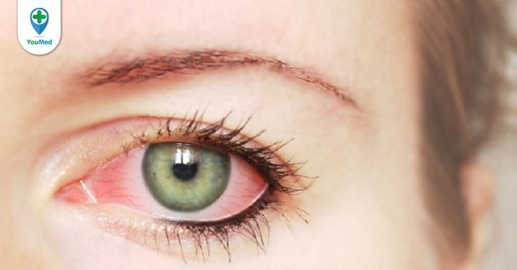 Đau mắt đỏ nhỏ thuốc gì? Lưu ý khi sử dụng từ bác sĩ