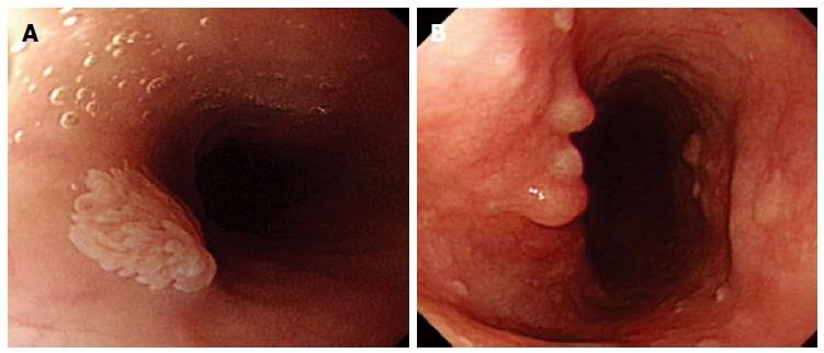 nhiễm HPV ở miệng và thực quản