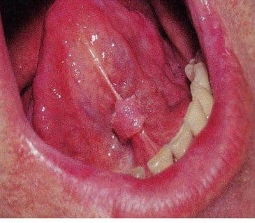 HPV gây sùi ở dưới lưỡi