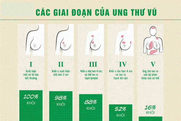 những giai đoạn của ung thư vú