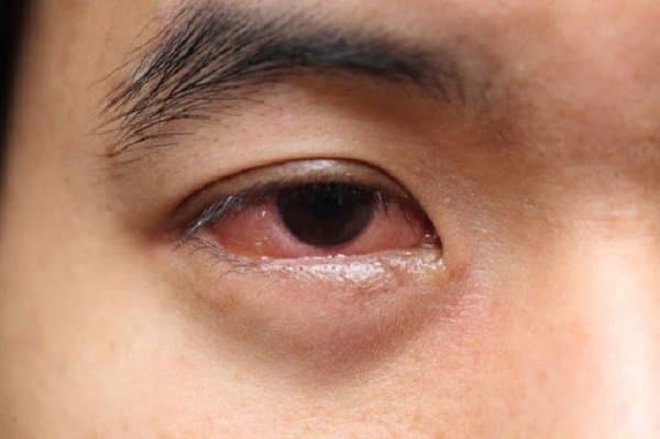Triệu chứng đau mắt hàn cần chú ý nhận biết sớm