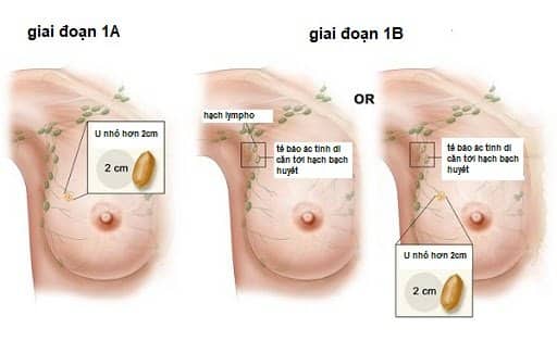Giai đoạn 1 của ung thư vú
