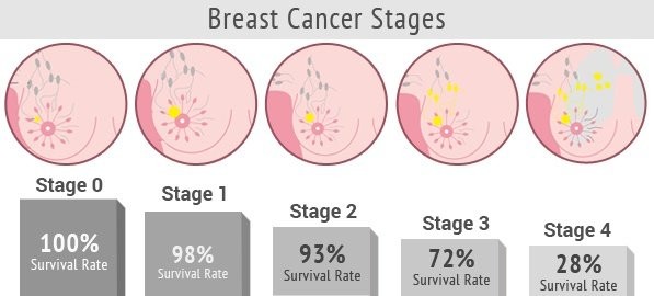 tỉ lệ sống còn sau điều trị của ung thư vú giai đoạn 1
