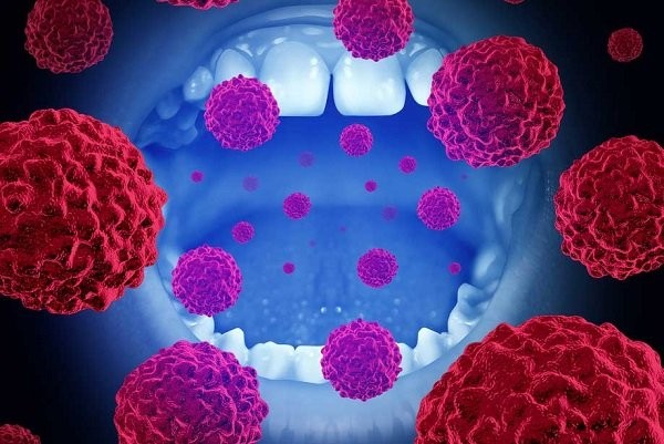Virus HPV là yếu tố nguy cơ gây ung thư miệng