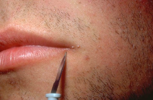 Chủng HPV gây bệnh da ở vùng mặt
