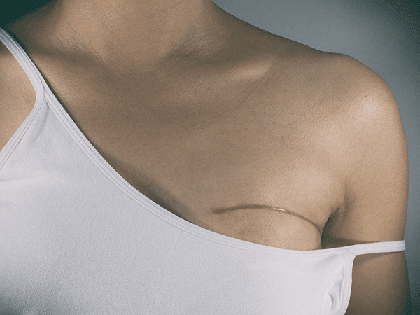 Xạ trị có thể áp dụng sau phẫu thuật cắt bỏ vú