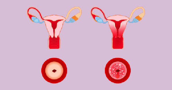 Hình ảnh minh hoạ ung thư cổ tử cung (bên phải)