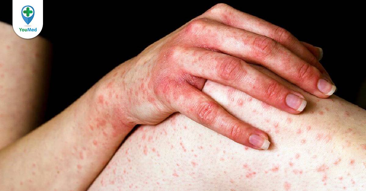 Cách điều trị khi bị dị ứng thuốc kháng sinh - YouMed
