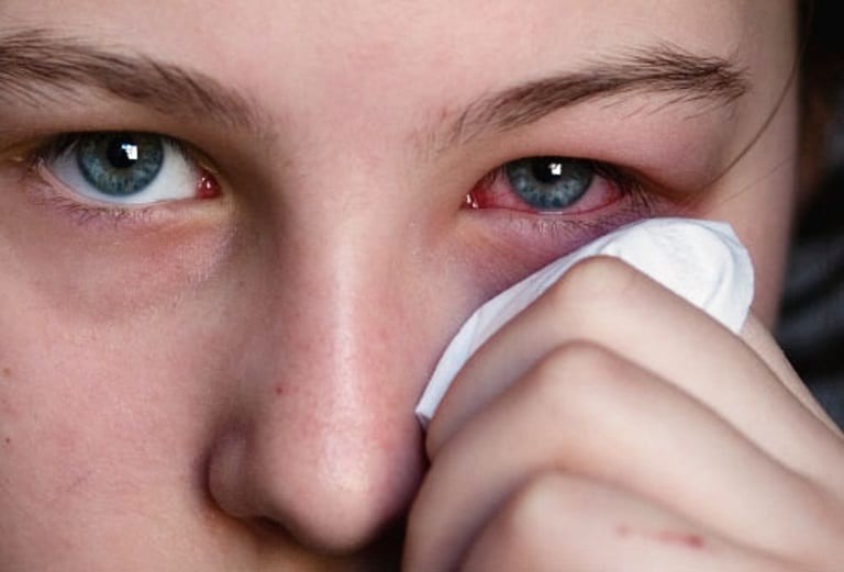 Khi tiếp xúc với những chất gây kích ứng, mắt có thể ngứa và đỏ