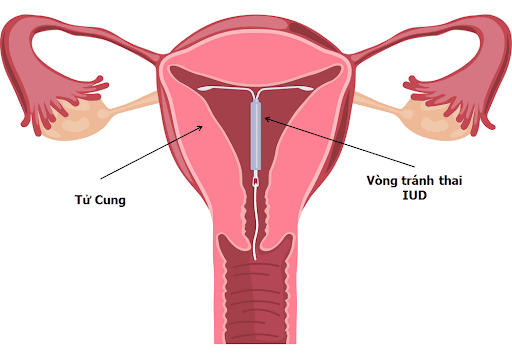 Một số dụng cụ tránh thai như vòng chữ T chứa đồng có thể gây vô kinh ở phụ nữ