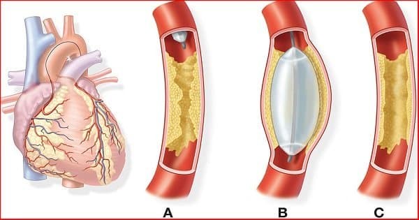Bệnh mạch vành do xơ vữa động mạch gây ra