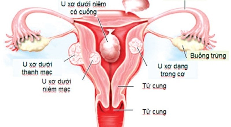 U xơ tử cung có thể gây cường kinh hoặc rong kinh