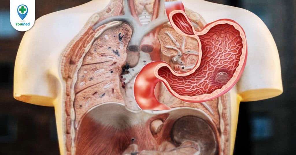 Ung thư phổi di căn gan: dấu hiệu, chẩn đoán và cách điều trị