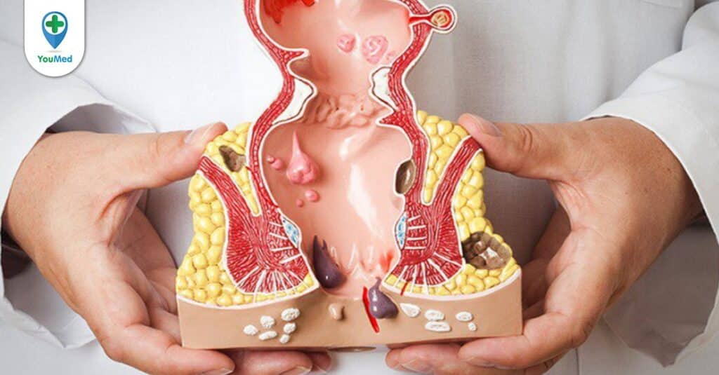 Ung thư hậu môn và những dấu hiệu cảnh báo sớm