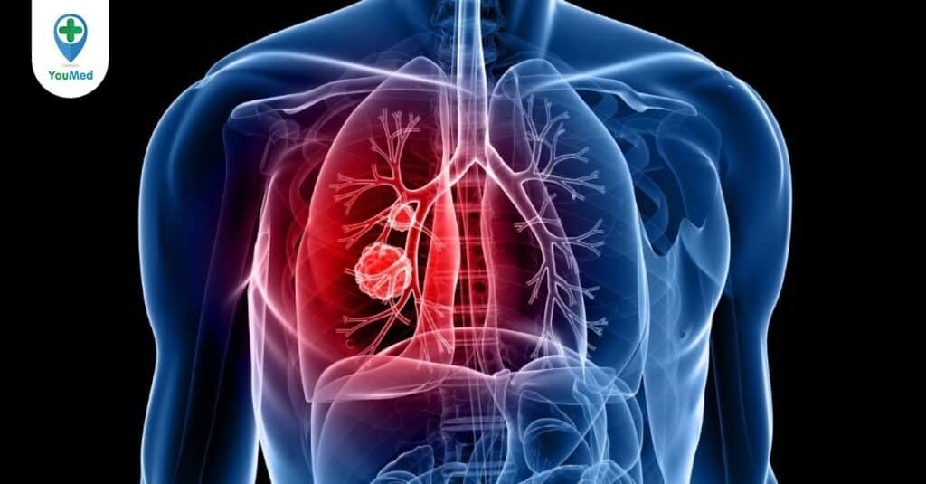 Đặc điểm, dấu hiệu và cách điều trị ung thư phổi giai đoạn đầu