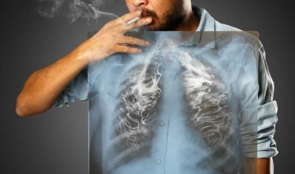 ung thư phổi sống được bao lâu phụ thuộc vào thói quen hút thuốc lá 