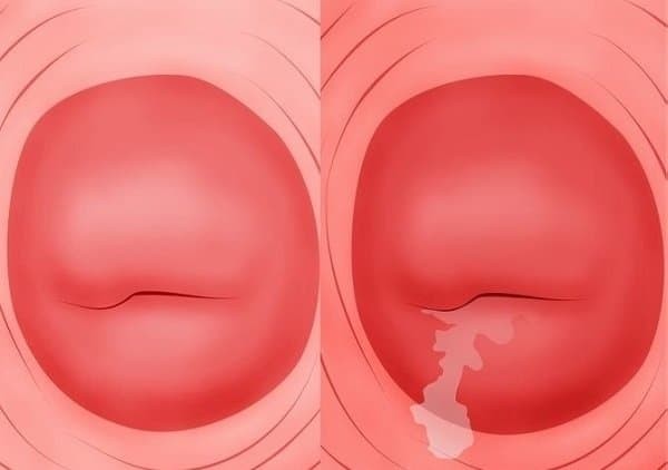 HÌnh 2: Dấu hiệu thường gặp của viêm cổ tử cung là chảy mủ bất thường vùng kín