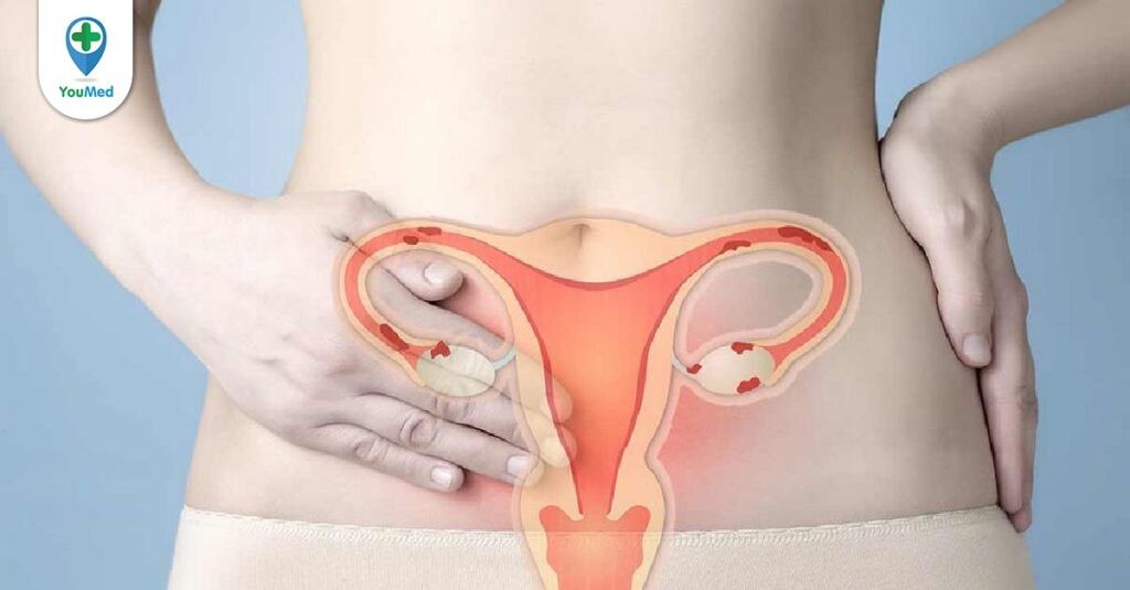 Viêm cổ tử cung là gì? Chẩn đoán và các phương pháp điều trị hiện nay