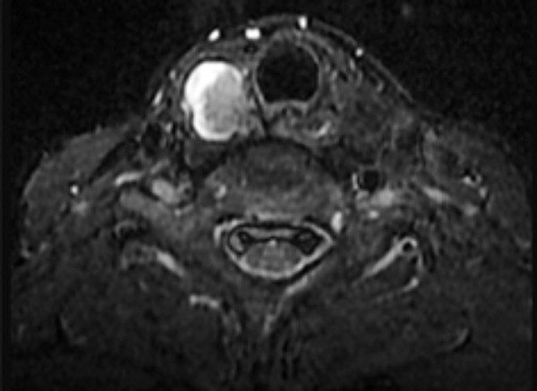 Ung thư tuyến giáp thùy phải dạng nhú (khối sang thương màu trắng) trên MRI-STIR T1 vùng cổ có chất cản từ