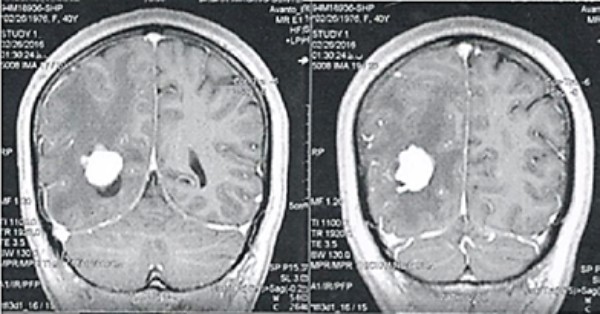 Khối di căn não (sang thương trắng) của ung thư tuyến giáp dạng nhú trên phim MRI sọ não có cản từ
