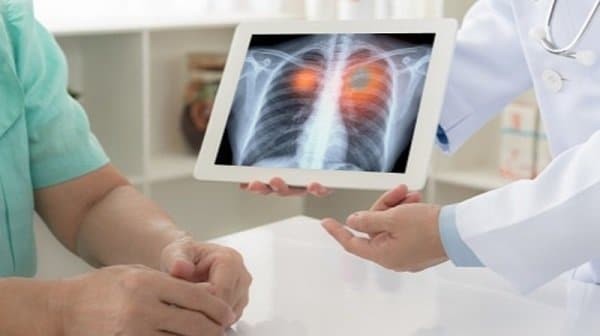 Bệnh ung thư phổi có lây không là câu hỏi được khá nhiều người quan tâm