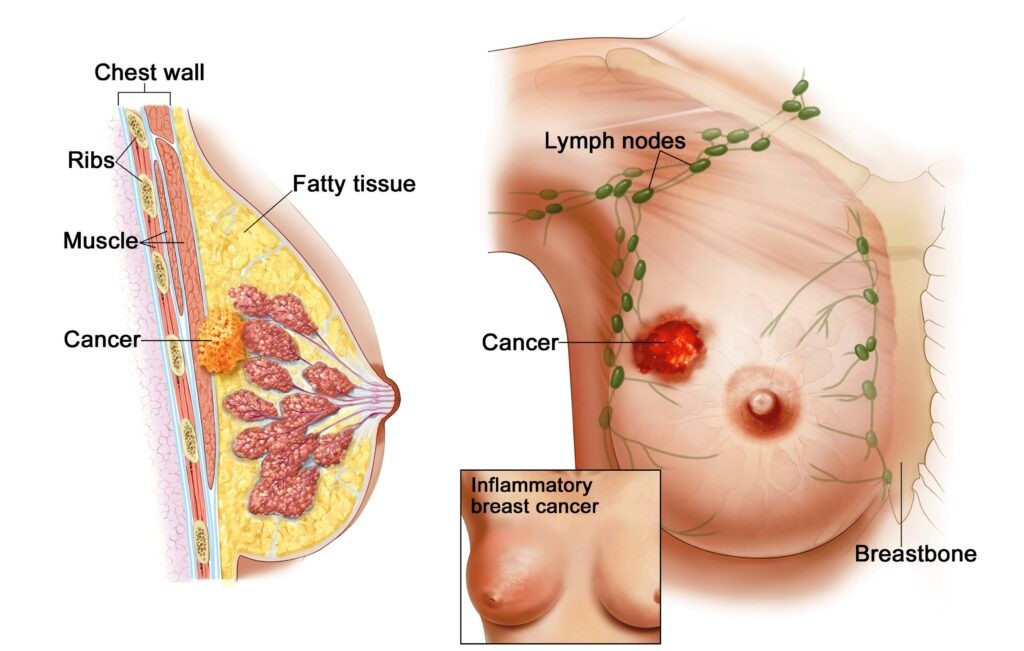 Ung thư vú là loại ung thư phát triển trong tế bào vú