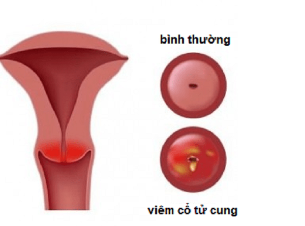 Hình ảnh cổ tử cung bình thường và viêm cổ tử cung.