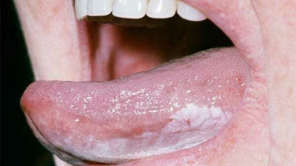 dấu hiệu ung thư lưỡi