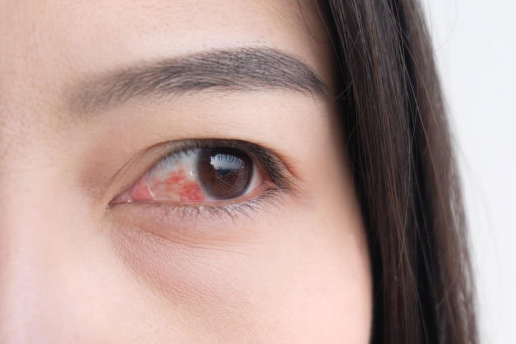 Đỏ mắt là một trong những tình trạng của thiếu vitamin B2