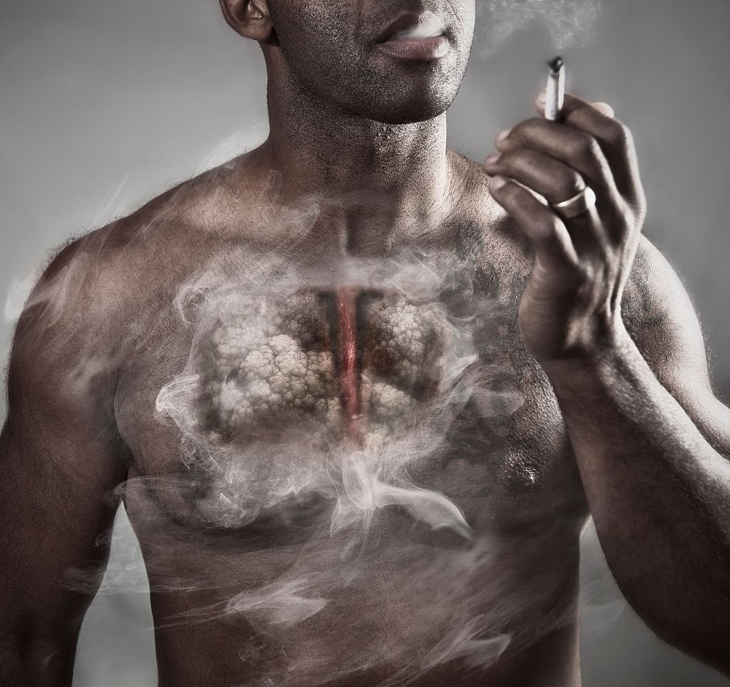 Hút thuốc là là một trong những nguyên nhân gây ung thư phổi