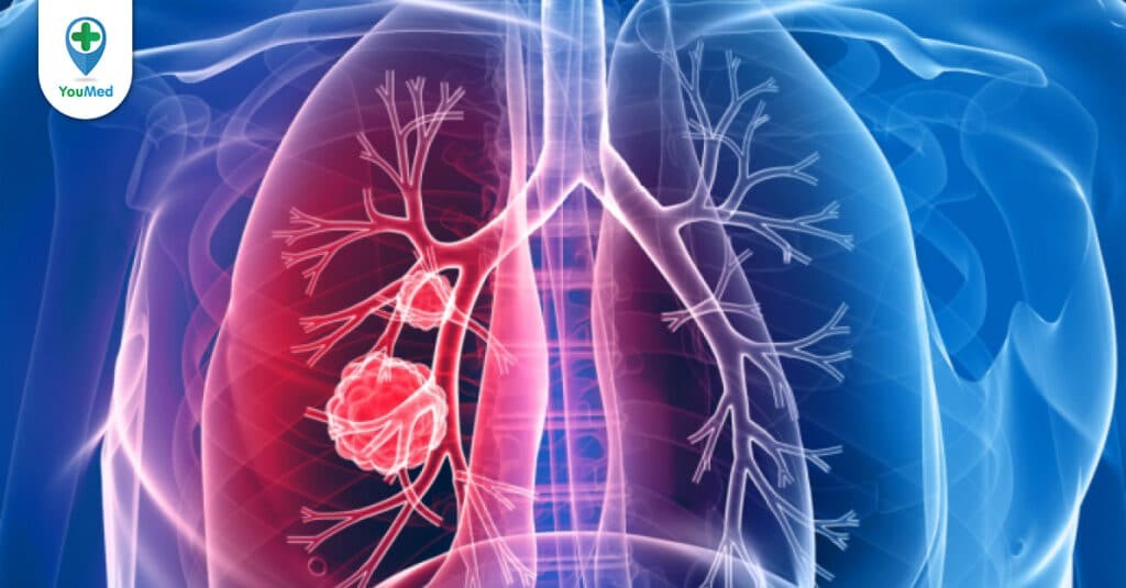 Tổng quan về ung thư phổi di căn hạch trung thất