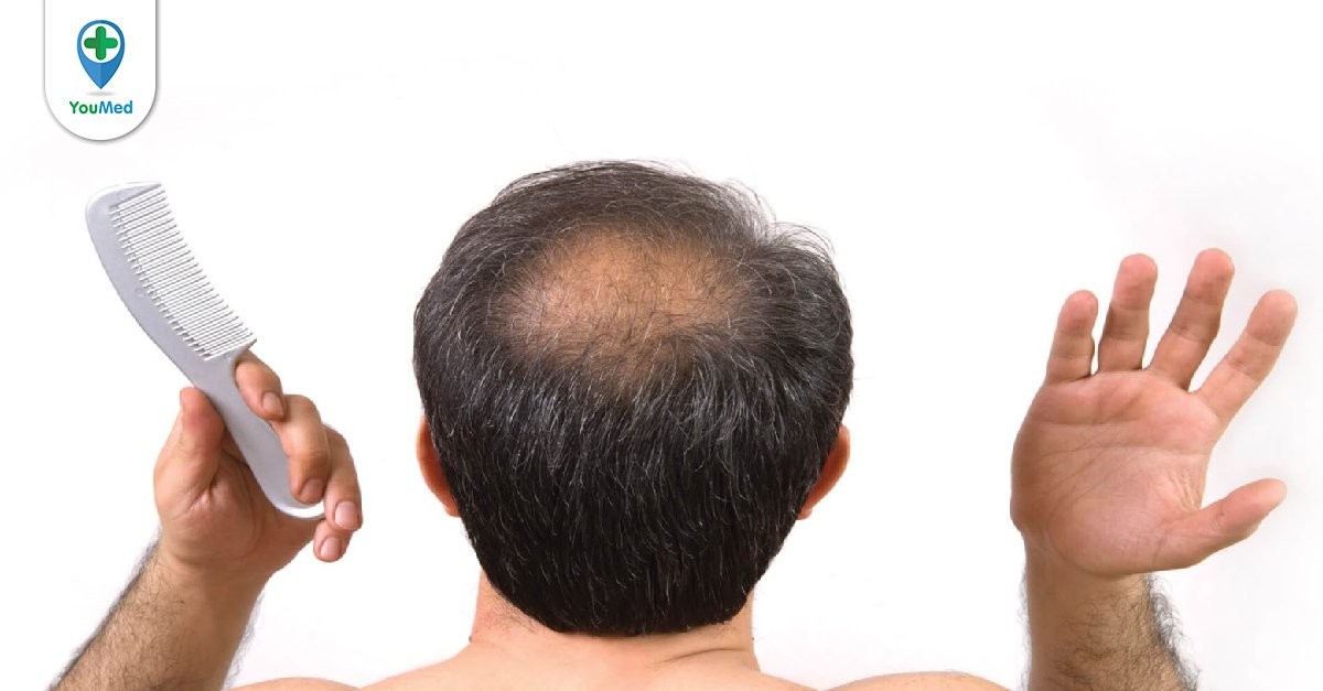 Nguyên nhân rụng tóc ở nam giới và cách khắc phục - YouMed