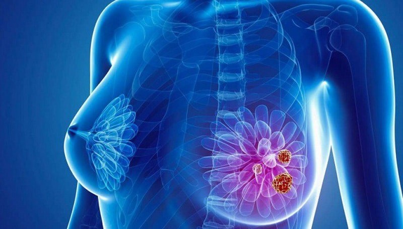 Tinh trùng có thể làm giảm nguy cơ mắc ung thư vú ở phụ nữ