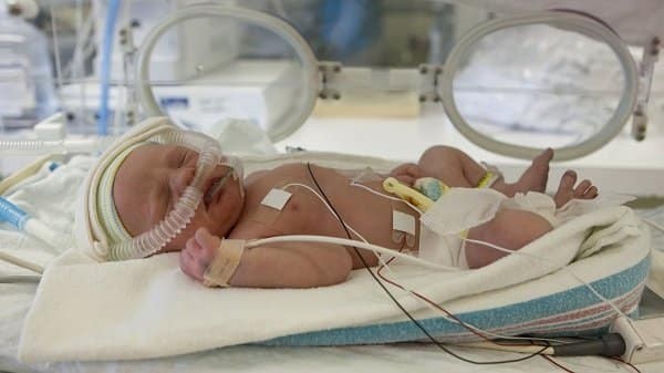 Hình 3: Trẻ sinh sớm cần được hỗ trợ hô hấp và theo dõi các chỉ số tim mạch, huyết áp liên tục