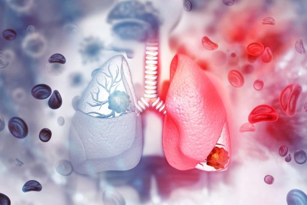Ung thư phổi tế bào nhỏ có 2 giai đoạn chính: Giai đoạn hạn chế và giai đoạn mở rộng