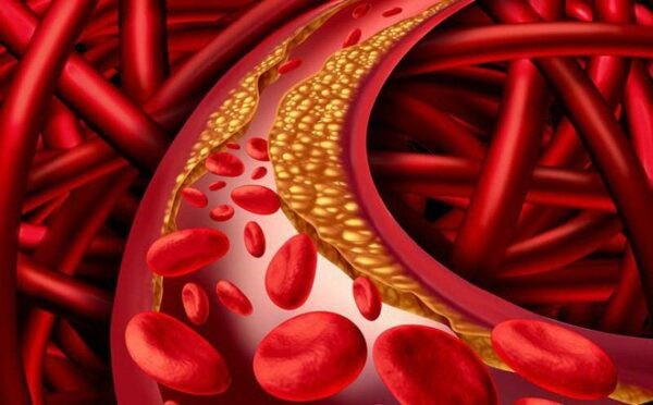 Tăng cholesterol máu là biến chứng của suy giáp có thể gây suy tim