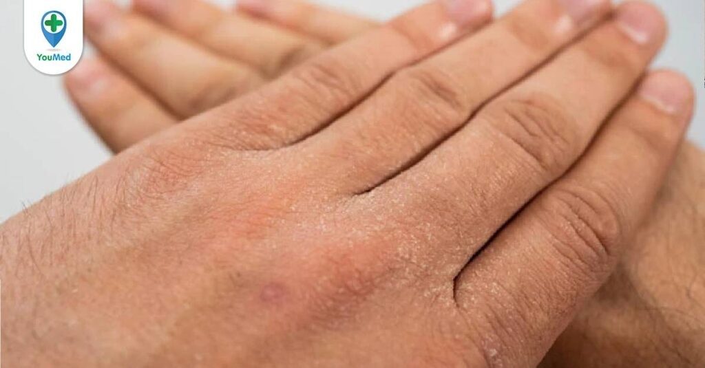 Viêm da tróc vảy: bệnh da hiếm gặp và những điều bạn cần biết
