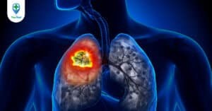 Những dấu hiệu ung thư phổi mà bạn nên biết