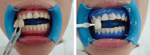 Tẩy trắng răng tại Bệnh viện Răng Hàm Mặt TPHCM