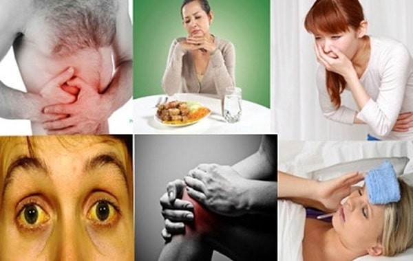 Các triệu chứng thường gặp của bệnh viêm gan A