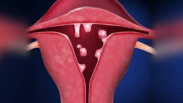 Khối polyp trong tử cung có thể gây ảnh hưởng đến chu kỳ kinh nguyệt