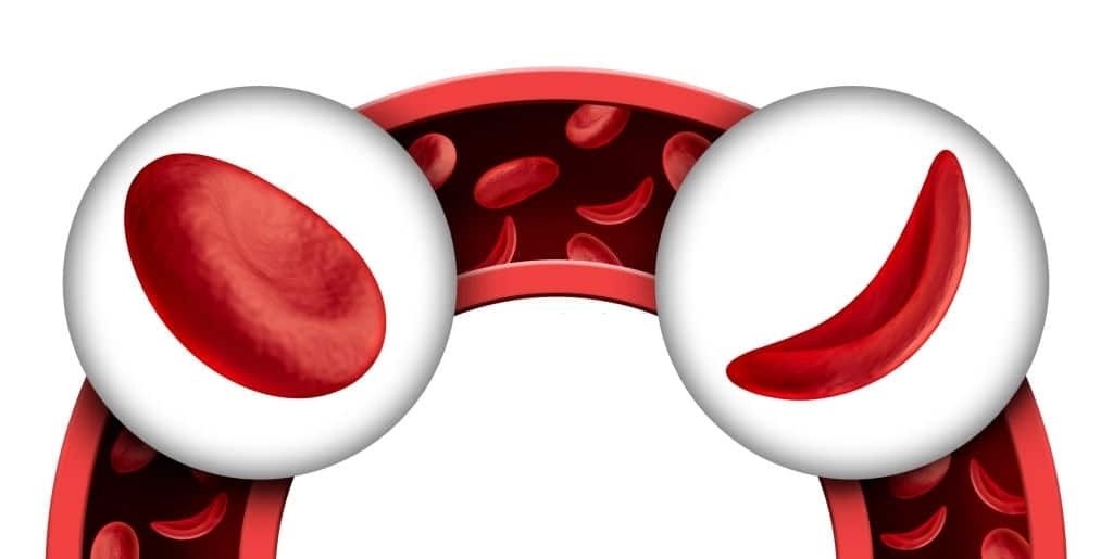 Khi đi qua những mạch máu nhỏ, hẹp, hồng cầu hình liềm sẽ bị vỡ, gây thiếu máu