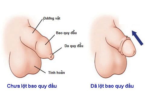 Lột bao quy đầu